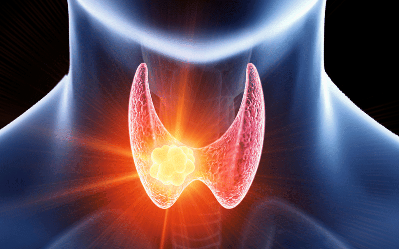 10 Aggressive Thyroid Cancer Symptoms Unveiling The Stealthy Predator