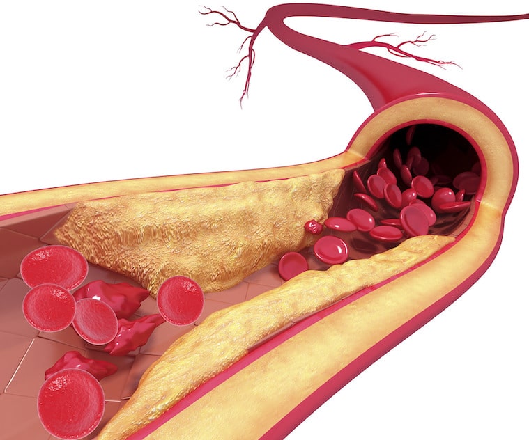 Atherosclerosis. Computer artwork of a narrowed artery, due to a cholesterol plaque.