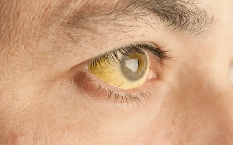 Jaundice - A Yellowing of the Skin and Eyes