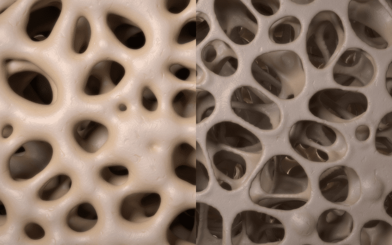 Osteoporosis- The Silent Thief of Bone Density