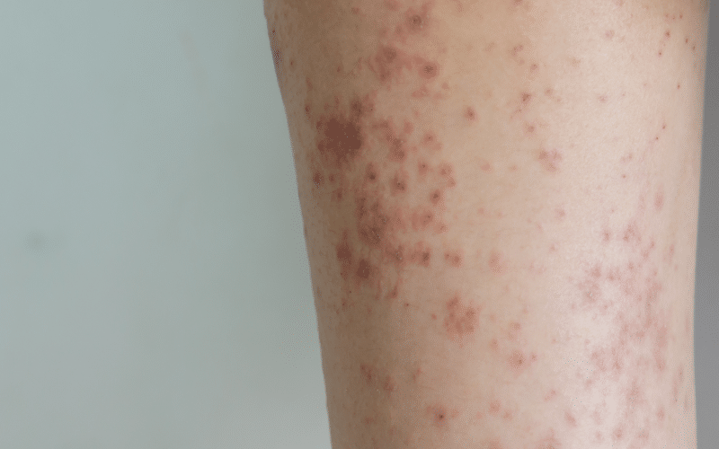 Skin Rash or Bumps