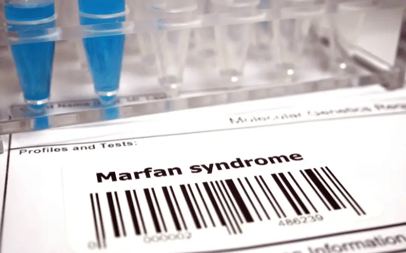 10 Revealing Marfan Syndrome Symptoms and Their Root Causes
