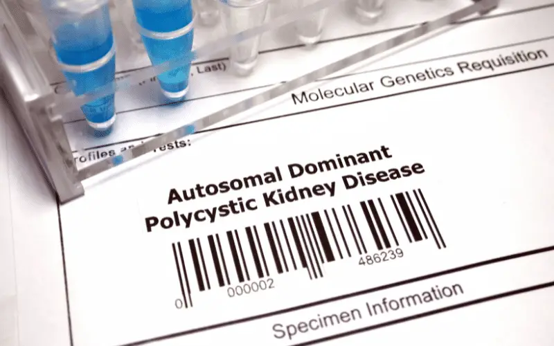 Polycystic Kidney Disease An In-Depth Look at 15 Symptoms