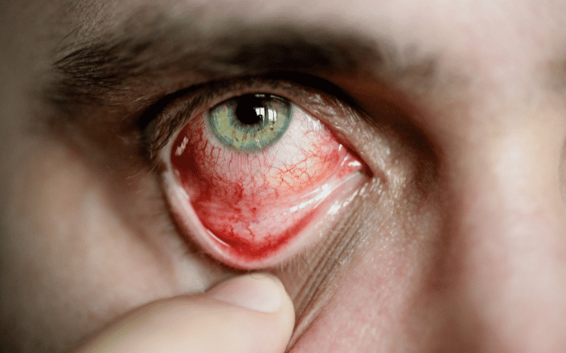 Redness of the Eye The Unmistakable Sign of Uveitis