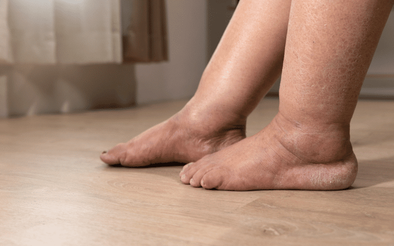 Swelling in the Legs, Ankles, and Feet A Classic Indicator of Hypervolemia
