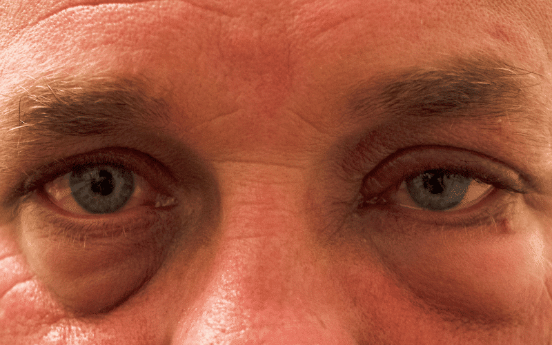 Swelling or Drooping of the Eye A Key Indicator of Cluster Headaches