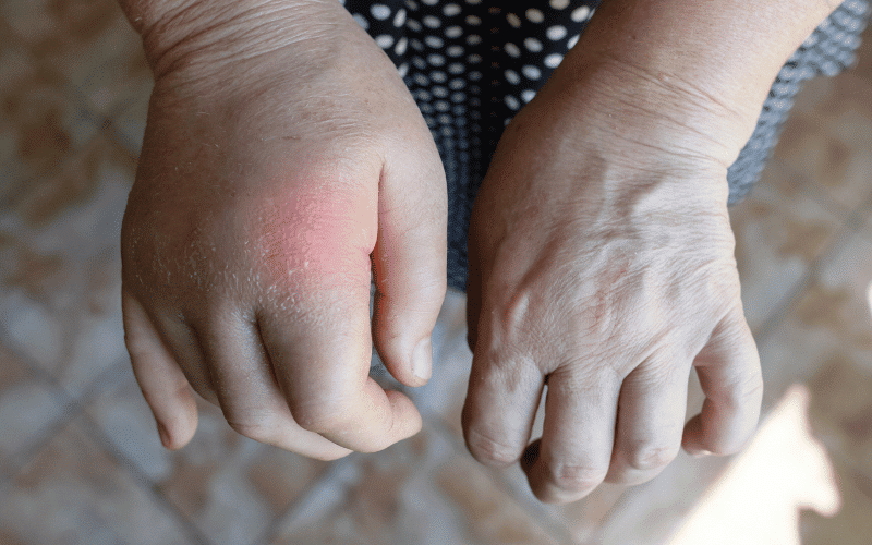 Swelling A Visible Sign of Rheumatoid Arthritis