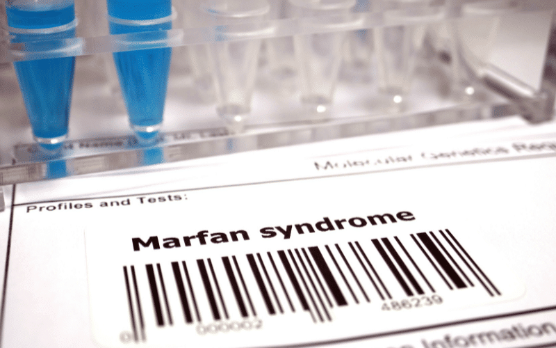 Marfan Syndrome A Genetic Disorder of Connective Tissue