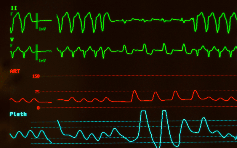 Rapid or Irregular Pulse The Unsettling Sign of Aortic Stenosis