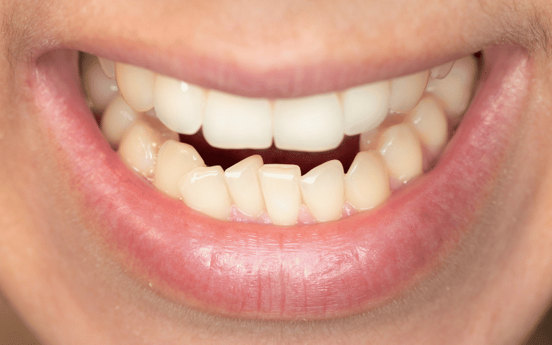 Dental Issues The Oral Health Struggles of Marfan Syndrome Patients