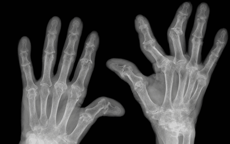 Joint Deformity The Long-Term Consequence of Rheumatoid Arthritis