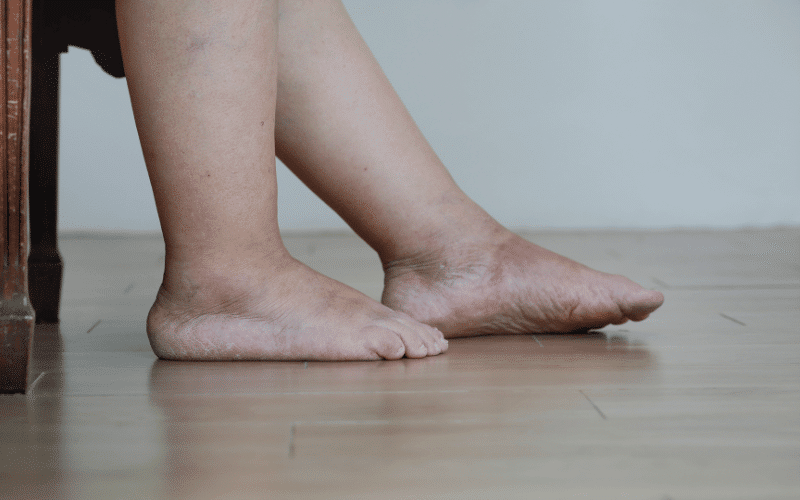 Swollen Ankles and Feet The Unseen Result of Aortic Stenosis