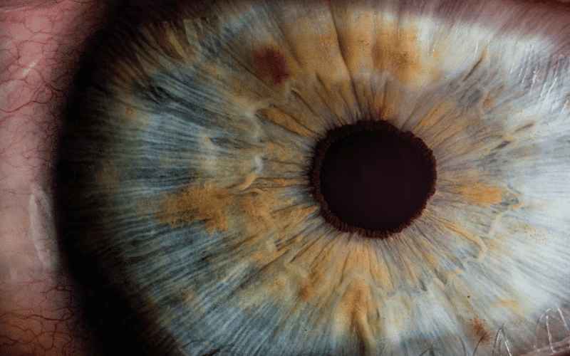 Changes in Pupil Size or Shape The Subtle Clues of Uveitis