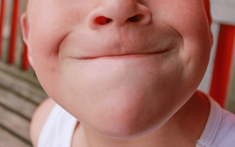 Distinctive Facial Features - The Unique Appearance of Alagille Syndrome