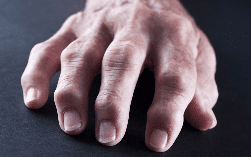 Rheumatoid Nodules A Distinctive Feature of Rheumatoid Arthritis