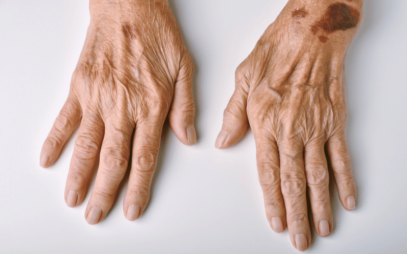 Skin Changes The Dermatological Manifestations of Amyloidosis