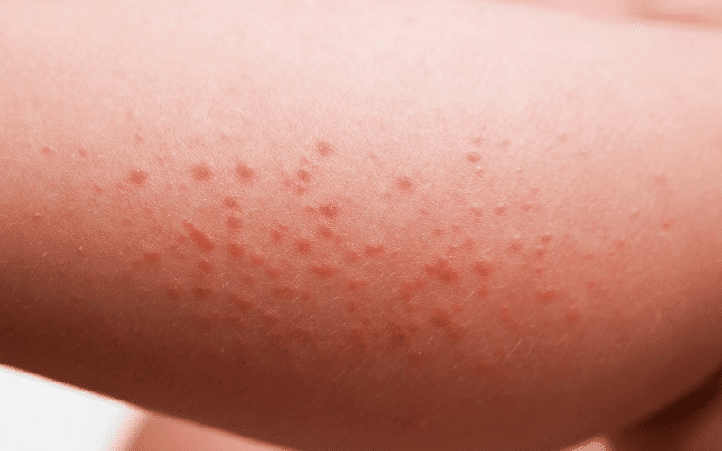 Skin Rashes An External Sign of Internal Distress