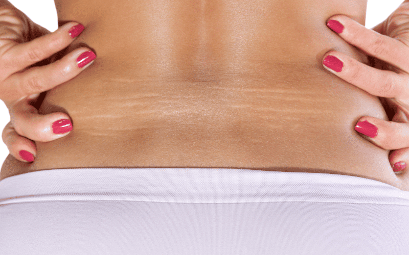 Stretch Marks The Skin's Silent Indicator of Marfan Syndrome