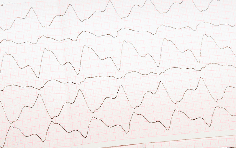 Altered Heart Rate or Rhythm A Cardiovascular Clue to Hypervolemia