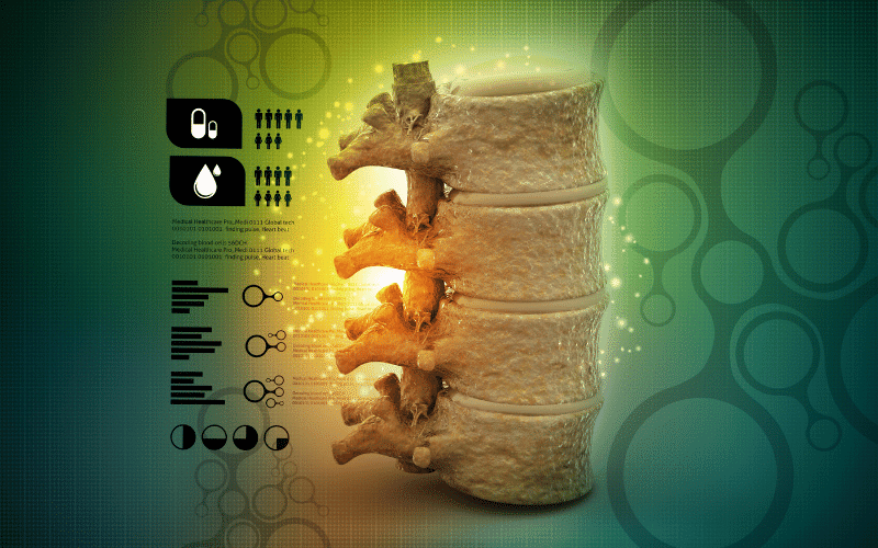 Dural Ectasia The Spine's Hidden Challenge in Marfan Syndrome