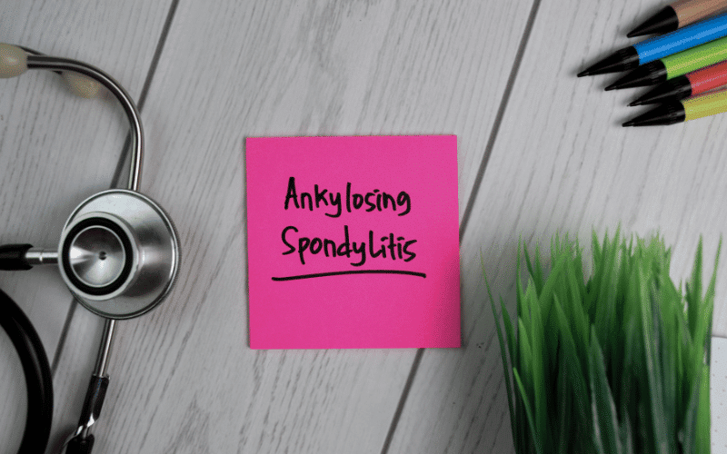 Ankylosing Spondylitis A Chronic Inflammatory Disease Affecting the Spine