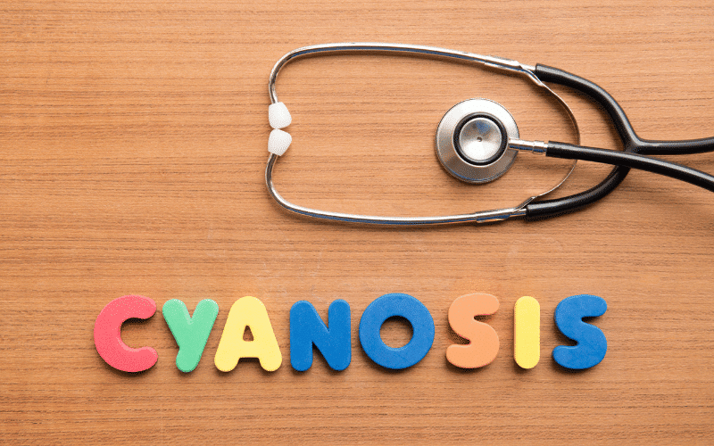 Cyanosis The Disconcerting Blue Tinge of Aortic Stenosis