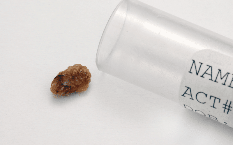 Kidney Stones An Unwanted Side Effect of Ulcerative Colitis