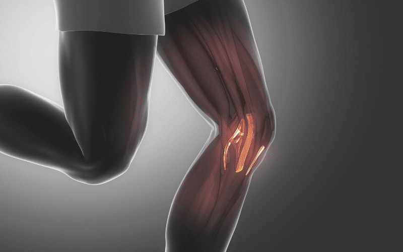 Mixed Connective Tissue Disease An Overlap of Autoimmune Disorders