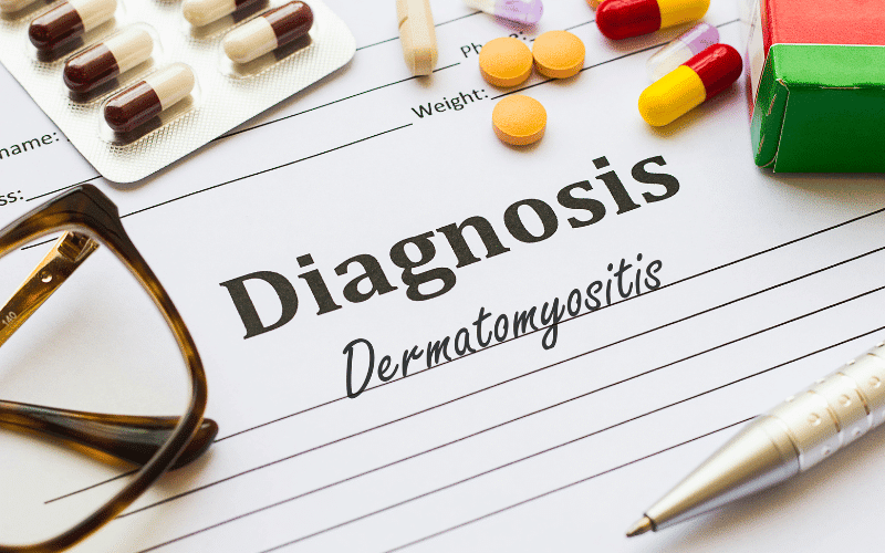 Dermatomyositis An Inflammatory Disease Affecting Muscles and Skin