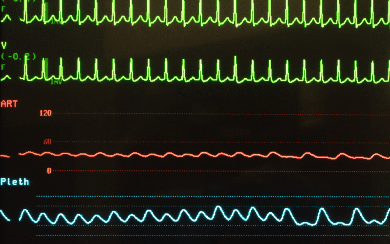 Rapid Heart Rate The Unsettling Consequence of Hyponatremia