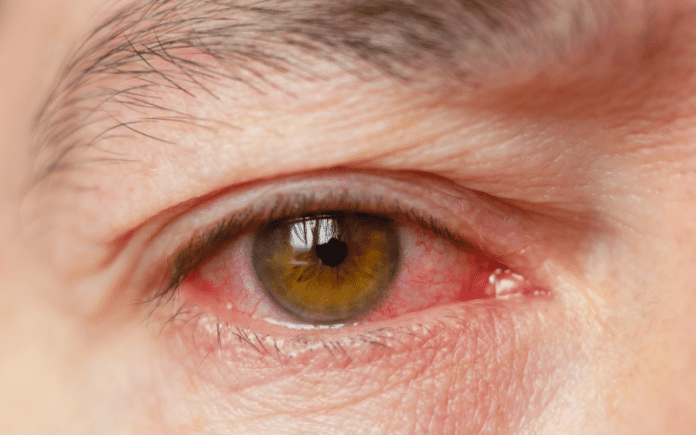 15 Symptoms Of Pink Eye Conjunctivitis You Shouldnt Ignore 