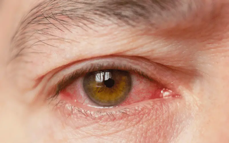15 Symptoms of Pink Eye (Conjunctivitis) You Shouldn't Ignore