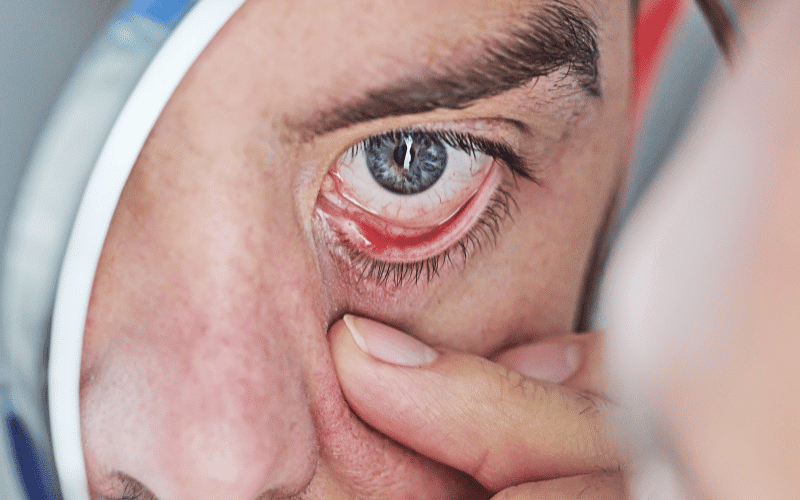 Dry Mouth and Eyes The Exocrine Expressions of Amyloidosis