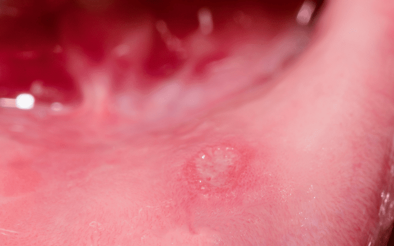 Mouth Ulcers The Uncommon Oral Manifestation of Diverticulitis