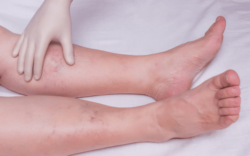 Chronic Venous Insufficiency