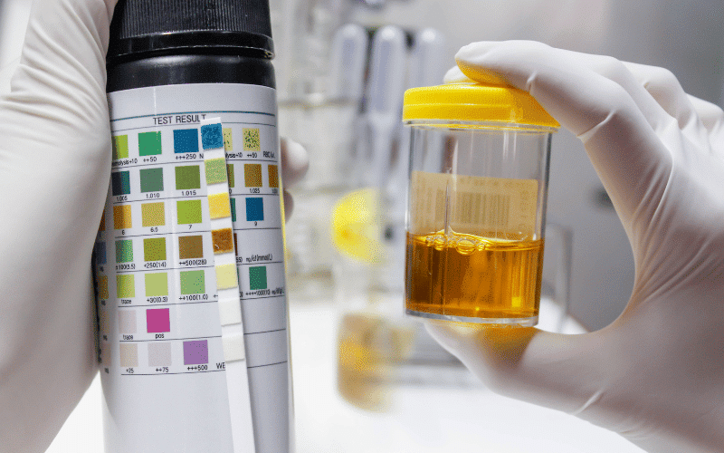 Dark Urine When Fluids Foreshadow Trouble