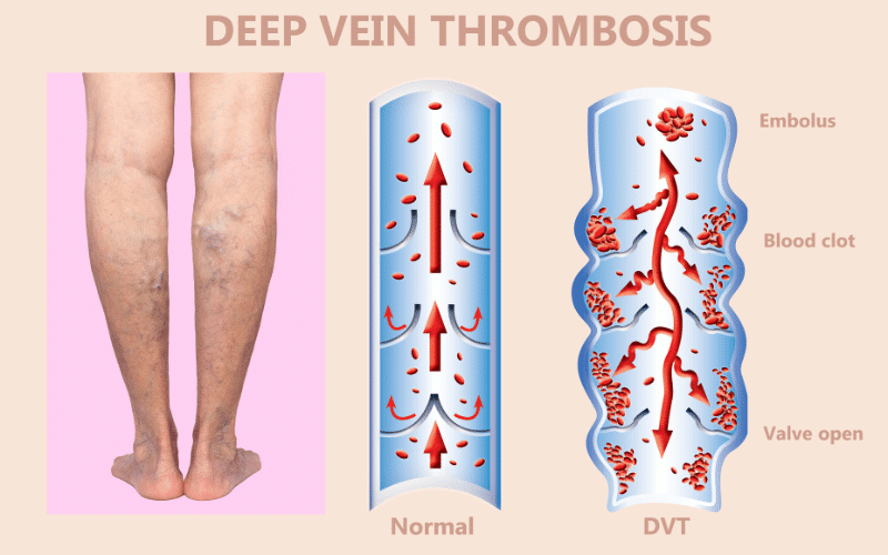 Deep Vein Thrombosis