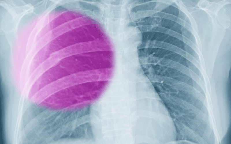 Deformed or Protruding Rib A Clear Indication of a Severe Fracture