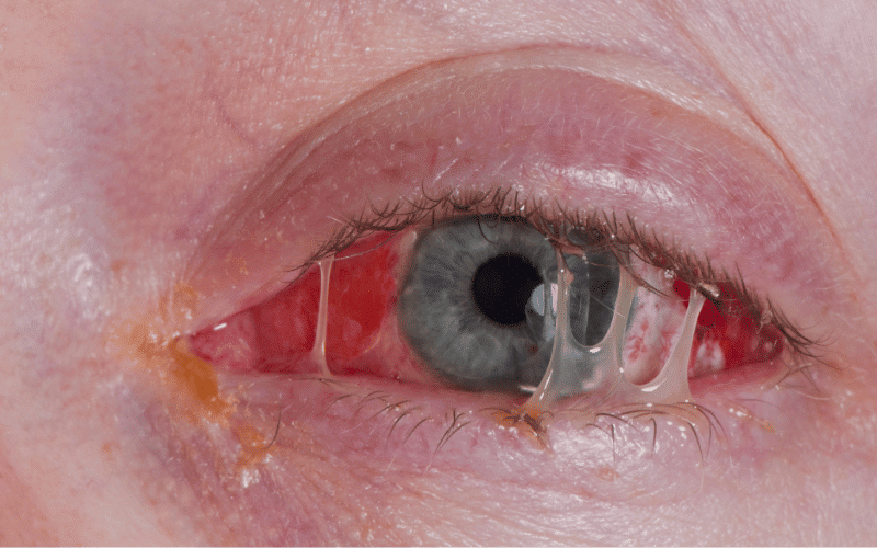 Discharge and Crusting- The Sticky Situation of Pink Eye