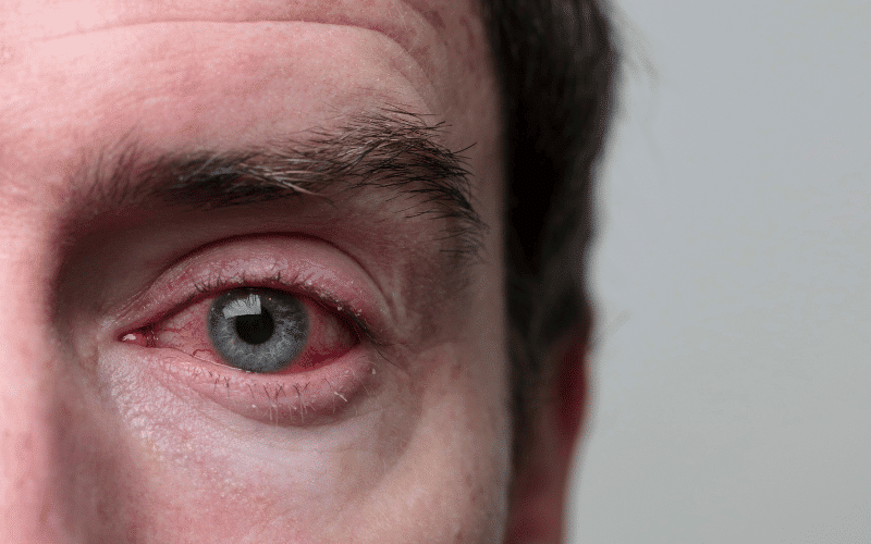 Disease 12. Blepharitis The Eyelid Irritant