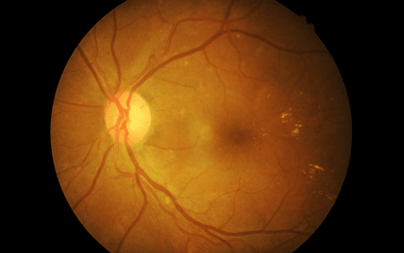 Disease 15. Retinal Detachment The Vision-threatening Emergency