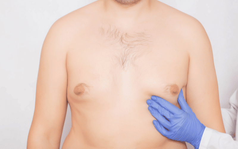 Gynecomastia Unwanted Breast Tissue Growth