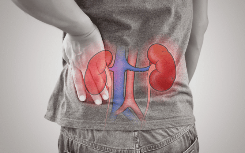 Hydronephrosis Swelling of the Kidneys Due to Urine Buildup