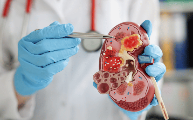 Interstitial Nephritis A Disruption in Kidney Function and Structure