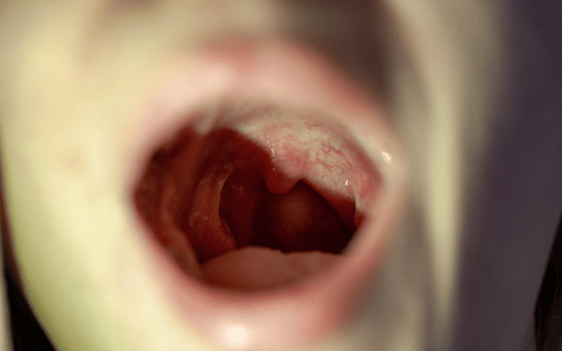 Mouth Sores and Difficulty Swallowing