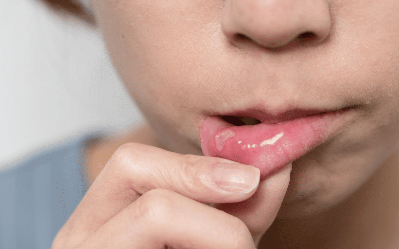 Mouth Sores and Ulcers Oral Complications of Severe Ulcerative Colitis