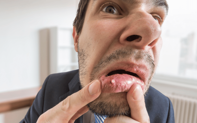 Mouth Ulcers - The Painful Oral Manifestation of Vasculitis