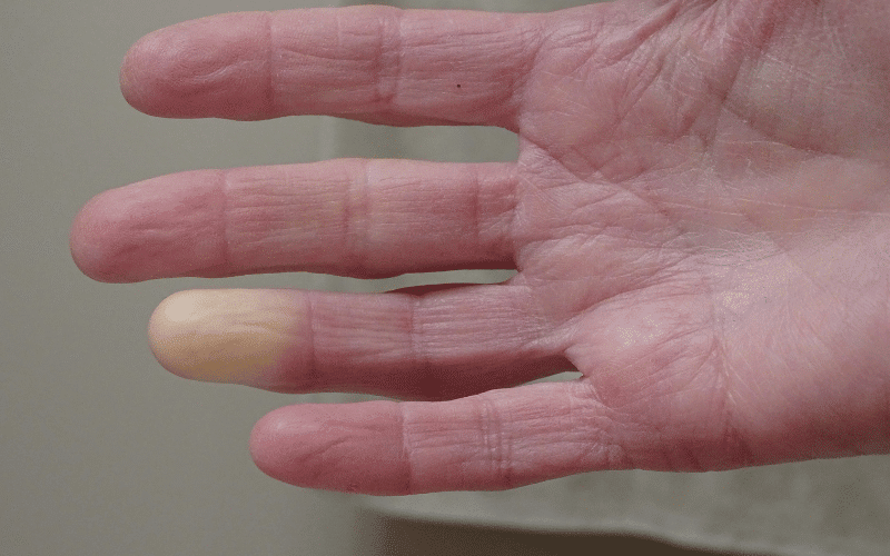 Raynaud's Phenomenon