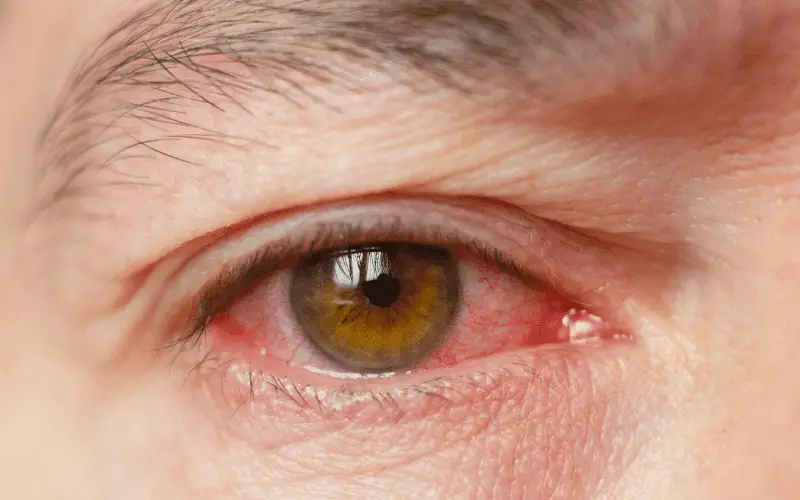 Redness and Swelling of the Eyelids A Clear Indicator of Inflammation