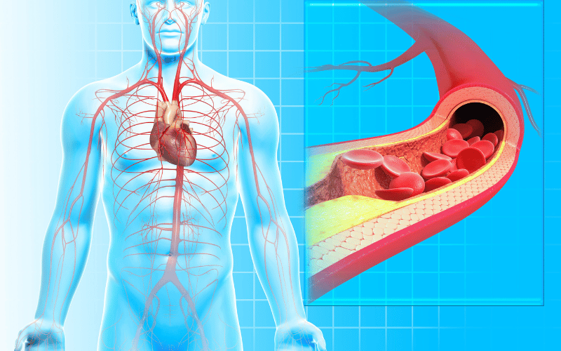 Renal Artery Stenosis Narrowing of the Arteries Supplying the Kidneys